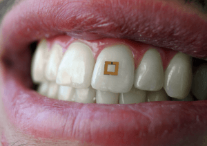 Tooth sensor checks your diet