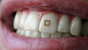 Tooth sensor checks your diet