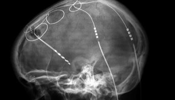 Tiefe Hirnstimulation. Von Dr. Craig Hacking, A.  und Prof. Frank Gaillard. CC BY-SA 4.0 Lizenz.