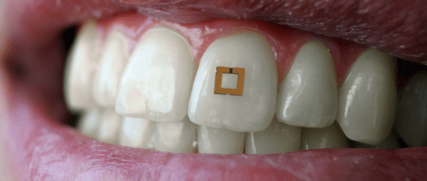 Zahnsensoren überwachen die Nahrungsaufnahme