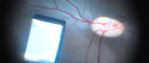 Spectaculaire implant oculaire