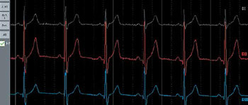 Elektorcardiagrama Android (1)