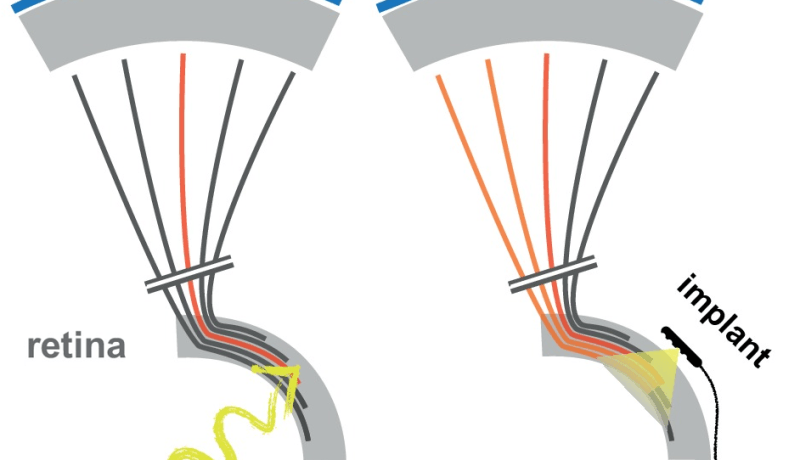 Déformation de l'image (en bleu) causée par la diffusion des courants de stimulation autour des électrodes de l'implant. D'après ​Probing the functional impact of sub-retinal prosthesis. Roux S., Matonti F., Dupont F., Hoffart L., Takerkart S., Picaud S.,