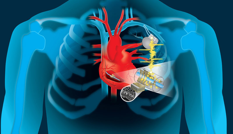 Batterie de pacemaker cherche cœur battant pour recharge