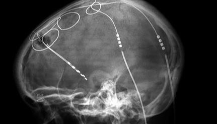 Diepe hersenstimulatie. Door: Dr. Craig Hacking, A. Prof Frank Gaillard. CC BY-SA 4.0 licentie.